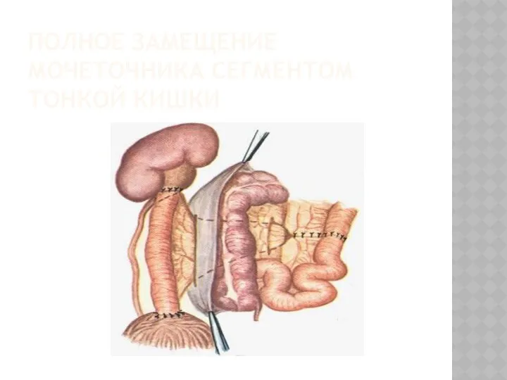ПОЛНОЕ ЗАМЕЩЕНИЕ МОЧЕТОЧНИКА СЕГМЕНТОМ ТОНКОЙ КИШКИ