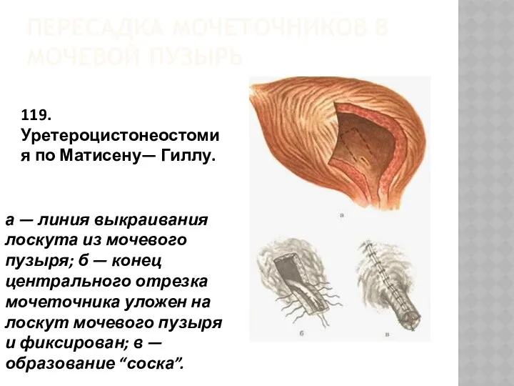 ПЕРЕСАДКА МОЧЕТОЧНИКОВ В МОЧЕВОЙ ПУЗЫРЬ 119. Уретероцистонеостомия по Матисену— Гиллу.