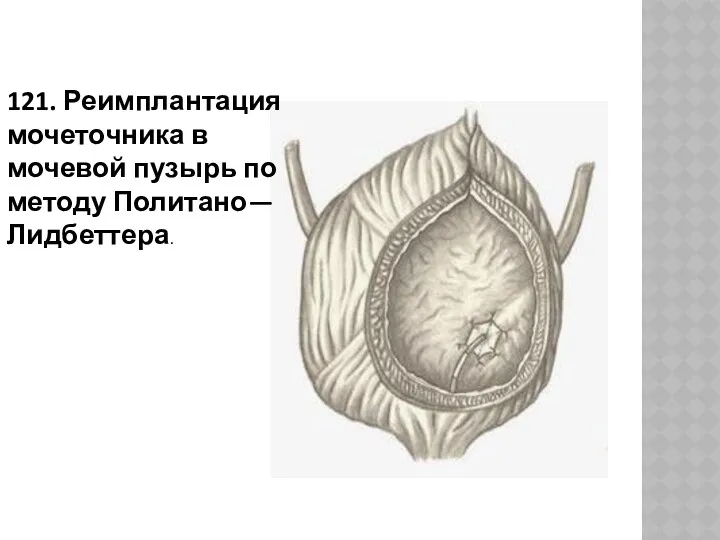 121. Реимплантация мочеточника в мочевой пузырь по методу Политано—Лидбеттера.