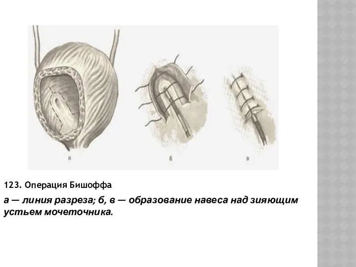123. Операция Бишоффа а — линия разреза; б, в — образование навеса над зияющим устьем мочеточника.