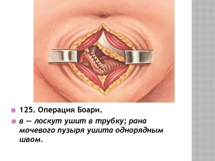 125. Операция Боари. в — лоскут ушит в трубку; рана мочевого пузыря ушита однорядным швом.