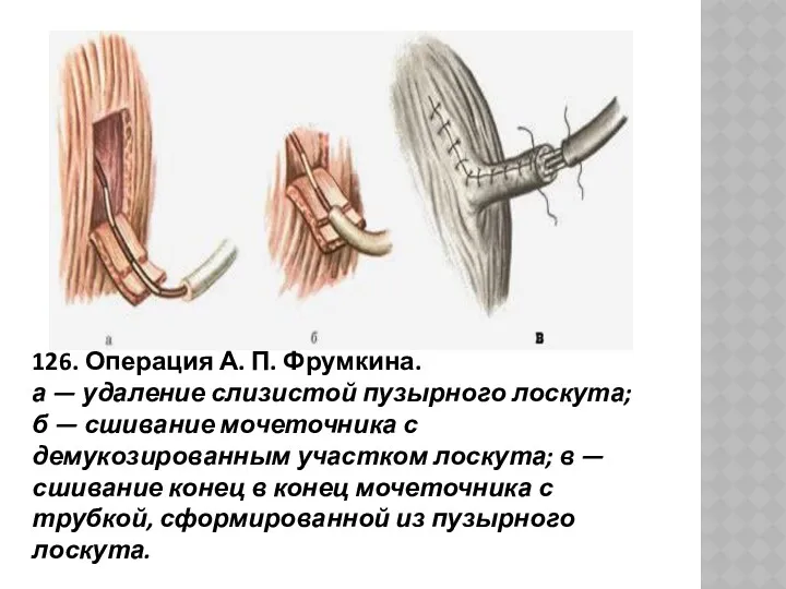 126. Операция А. П. Фрумкина. а — удаление слизистой пузырного