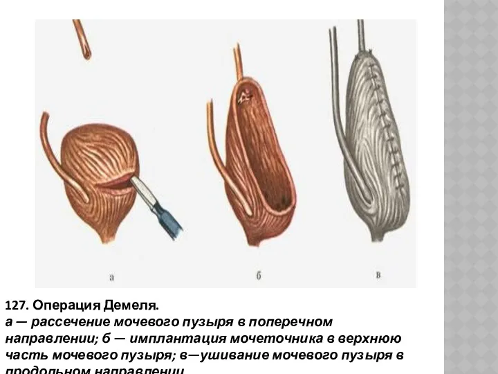 127. Операция Демеля. а — рассечение мочевого пузыря в поперечном