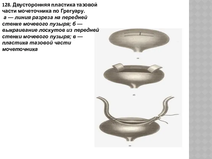 128. Двусторонняя пластика тазовой части мочеточника по Грегуару. а —