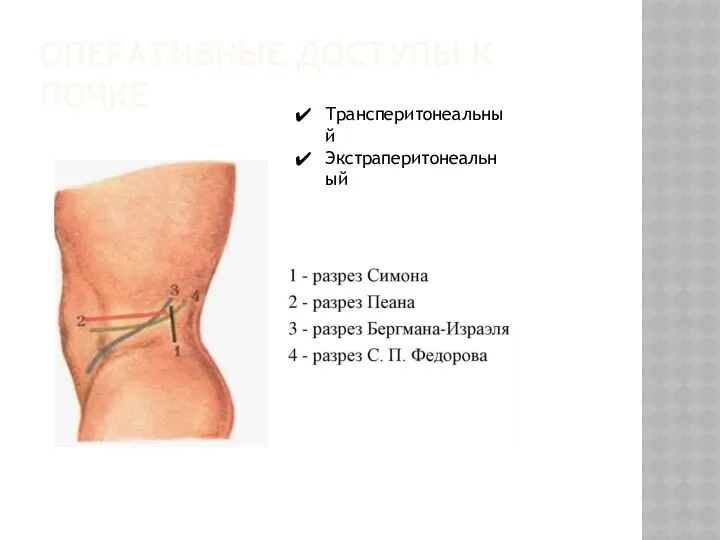 ОПЕРАТИВНЫЕ ДОСТУПЫ К ПОЧКЕ Трансперитонеальный Экстраперитонеальный