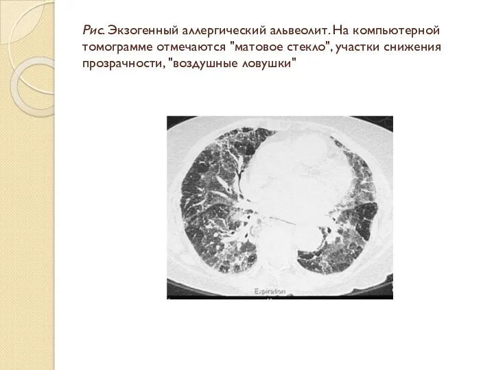 Рис. Экзогенный аллергический альвеолит. На компьютерной томограмме отмечаются "матовое стекло", участки снижения прозрачности, "воздушные ловушки"