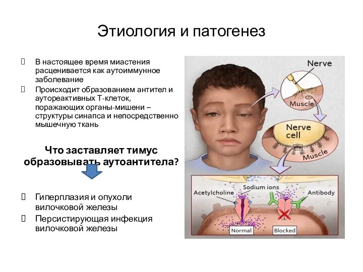 Этиология и патогенез В настоя­щее время миастения расценивается как аутоиммунное