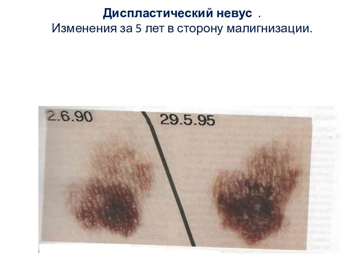 Диспластический невус . Изменения за 5 лет в сторону малигнизации.