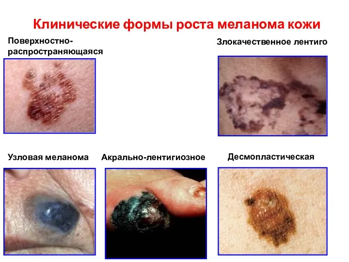 Клинические формы роста меланома кожи Поверхностно- распространяющаяся Злокачественное лентиго Узловая меланома Акрально-лентигиозное Десмопластическая