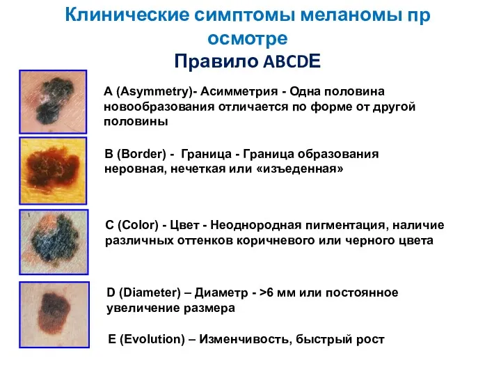 Клинические симптомы меланомы пр осмотре Правило ABCDЕ А (Asymmetry)- Асимметрия