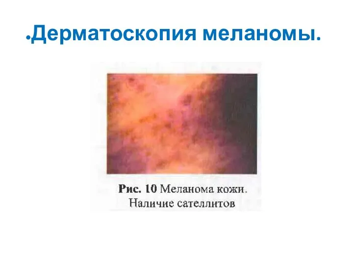 Дерматоскопия меланомы.