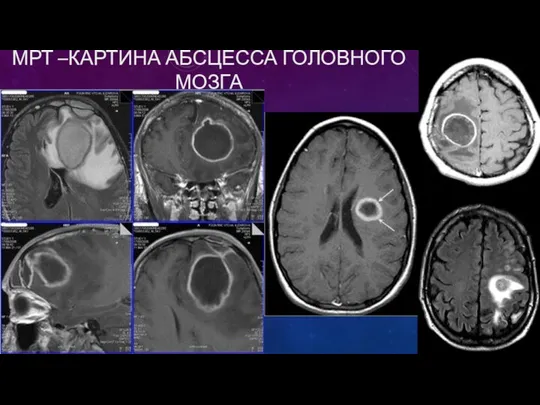 МРТ –КАРТИНА АБСЦЕССА ГОЛОВНОГО МОЗГА