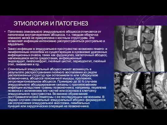 ЭТИОЛОГИЯ И ПАТОГЕНЕЗ Патогенез спинального эпидурального абсцесса отличается от патогенеза