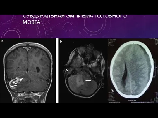 СУБДУРАЛЬНАЯ ЭМПИЕМА ГОЛОВНОГО МОЗГА