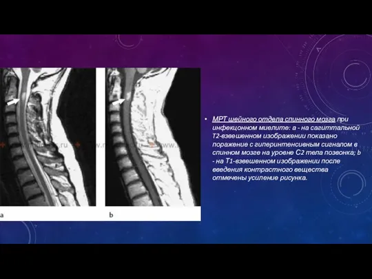 МРТ шейного отдела спинного мозга при инфекцонном миелите: а -