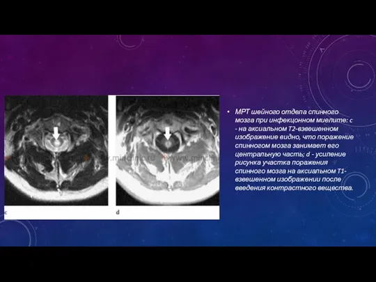 МРТ шейного отдела спинного мозга при инфекцонном миелите: c -