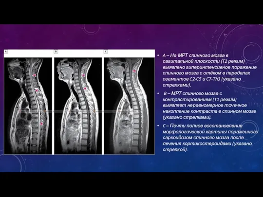 A – На МРТ спинного мозга в сагитальной плоскости (T2