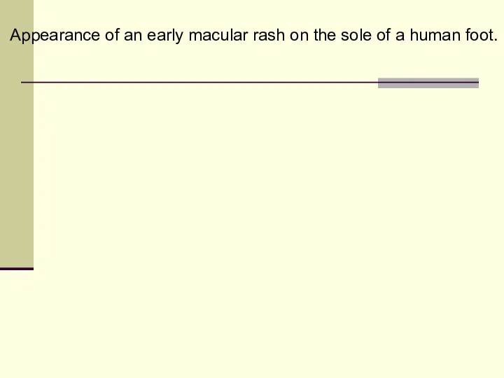 Appearance of an early macular rash on the sole of a human foot.