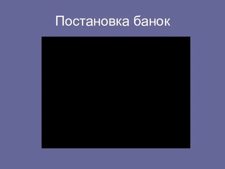 Постановка банок