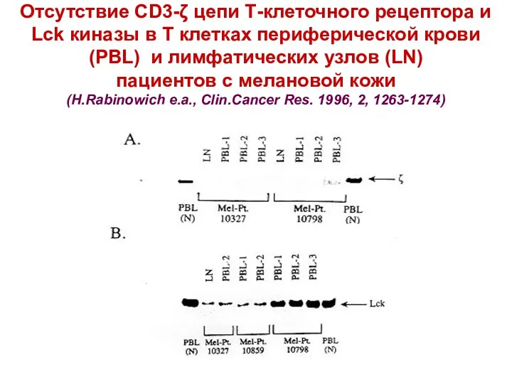 Отсутствие CD3-ζ цепи Т-клеточного рецептора и Lck киназы в Т