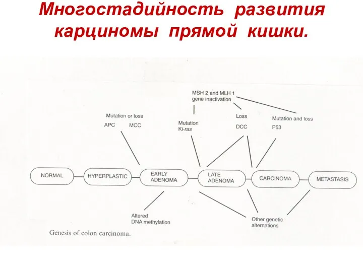 Многостадийность развития карциномы прямой кишки.