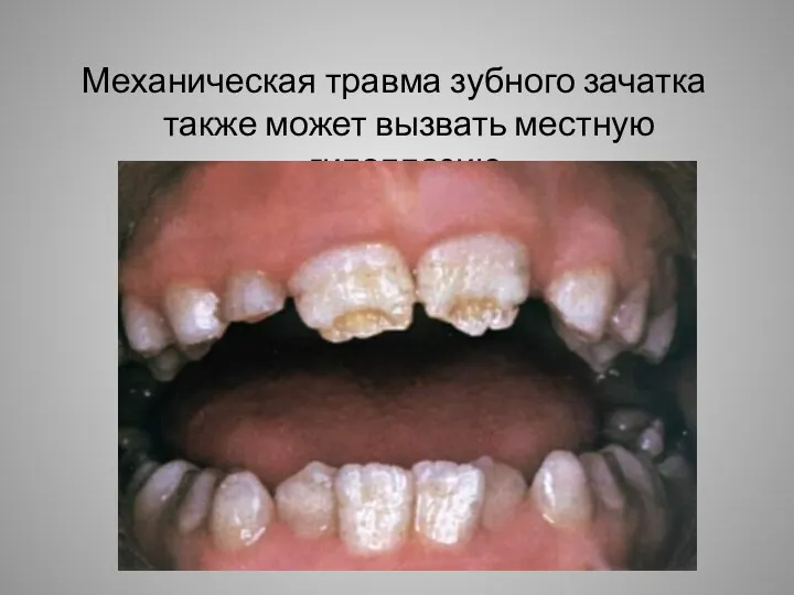 Механическая травма зубного зачатка также может вызвать местную гипоплазию.