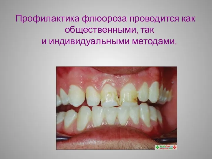 Профилактика флюороза проводится как общественными, так и индивидуальными методами.