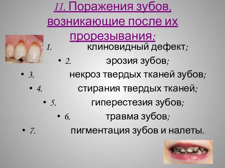 II. Поражения зубов, возникающие после их прорезывания: 1. клиновидный дефект;