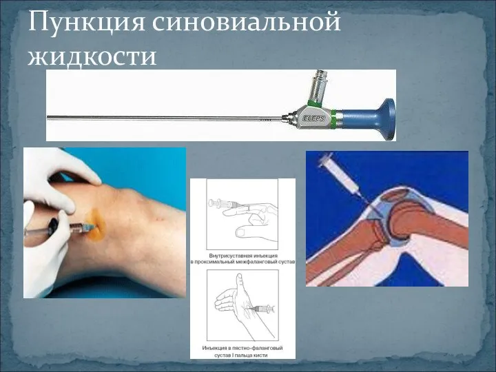 Пункция синовиальной жидкости