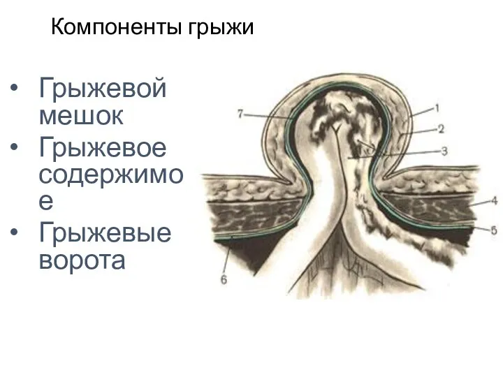 Компоненты грыжи Грыжевой мешок Грыжевое содержимое Грыжевые ворота