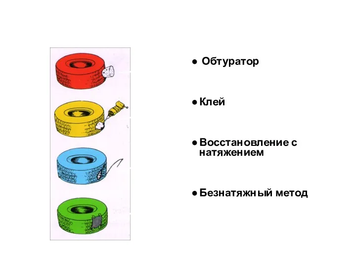 Принципы герниопластики Обтуратор Клей Восстановление с натяжением Безнатяжный метод