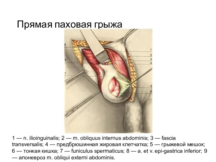 Прямая паховая грыжа 1 — n. ilioinguinalis; 2 — m.