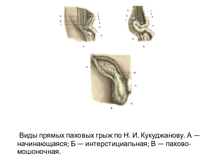 Виды прямых паховых грыж по Н. И. Кукуджанову. А —