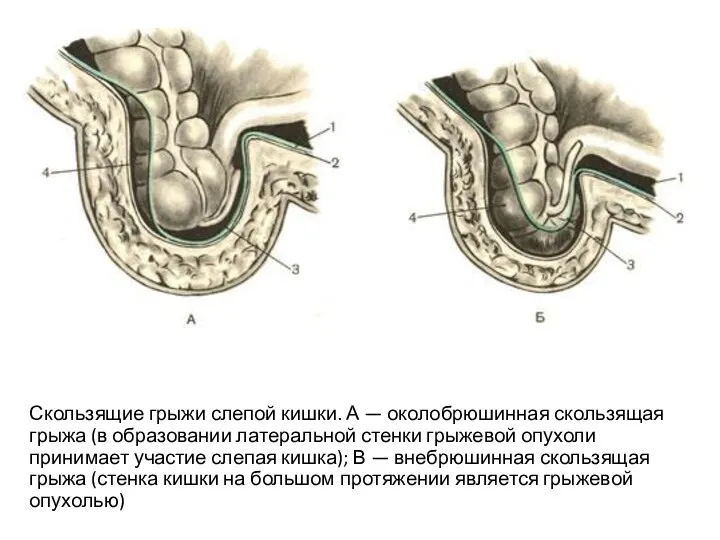 Скользящие грыжи слепой кишки. А — околобрюшинная скользящая грыжа (в