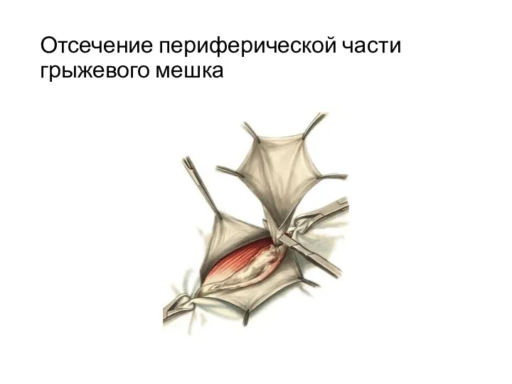 Отсечение периферической части грыжевого мешка