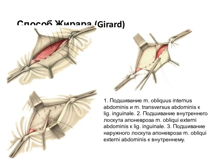Способ Жирара (Girard) 1. Подшивание m. obliquus internus abdominis и