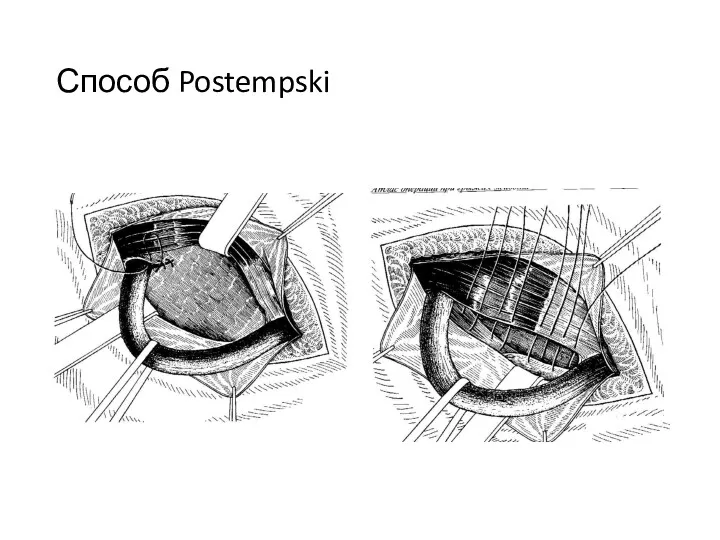 Способ Postempski