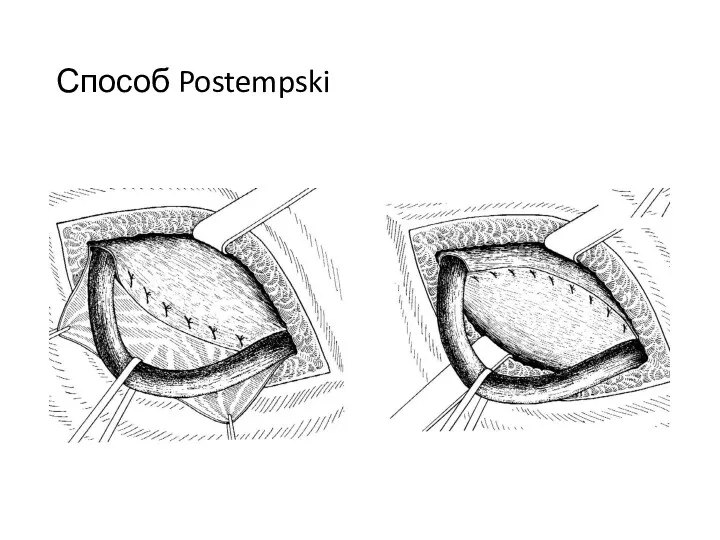 Способ Postempski