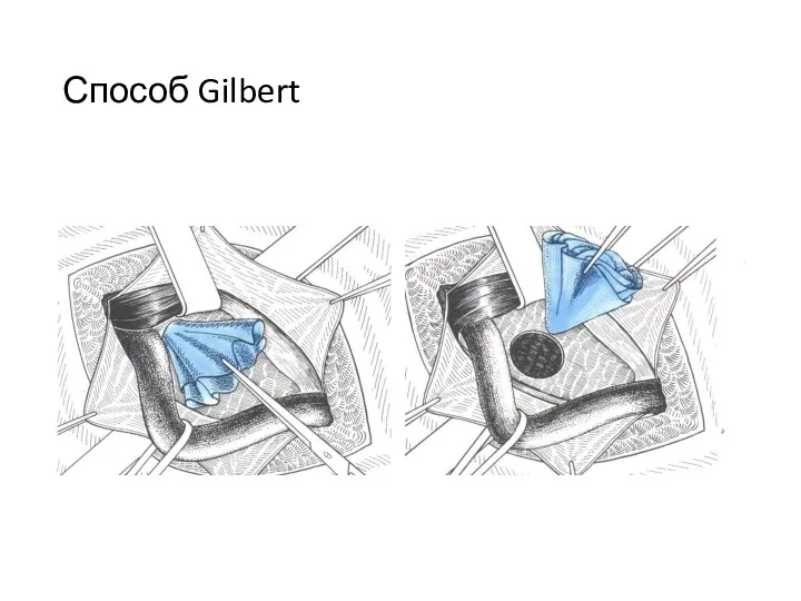 Способ Gilbert