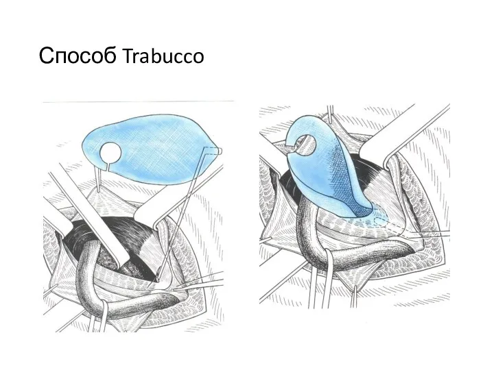 Способ Trabucco