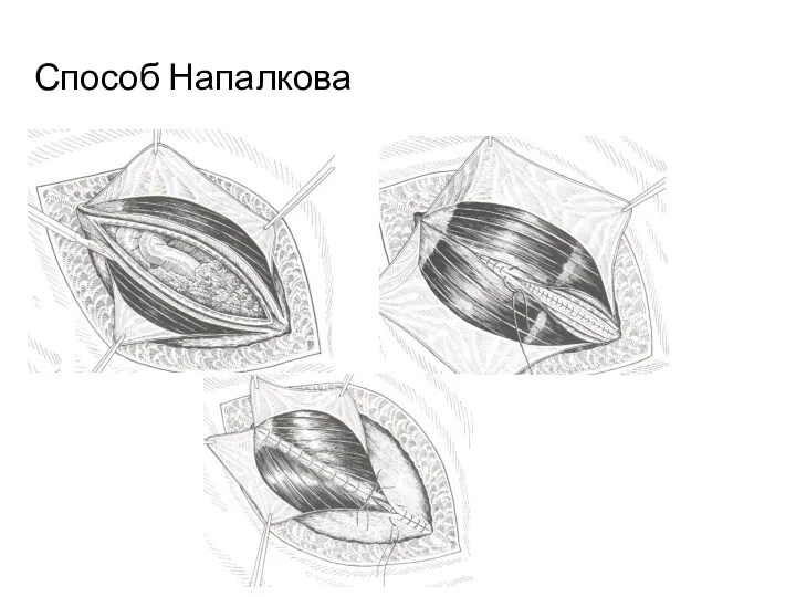 Способ Напалкова