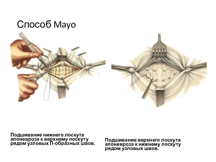 Способ Mayo Подшивание нижнего лоскута апоневроза к верхнему лоскуту рядом