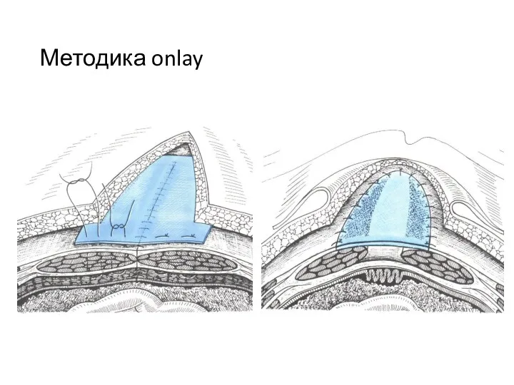 Методика onlay