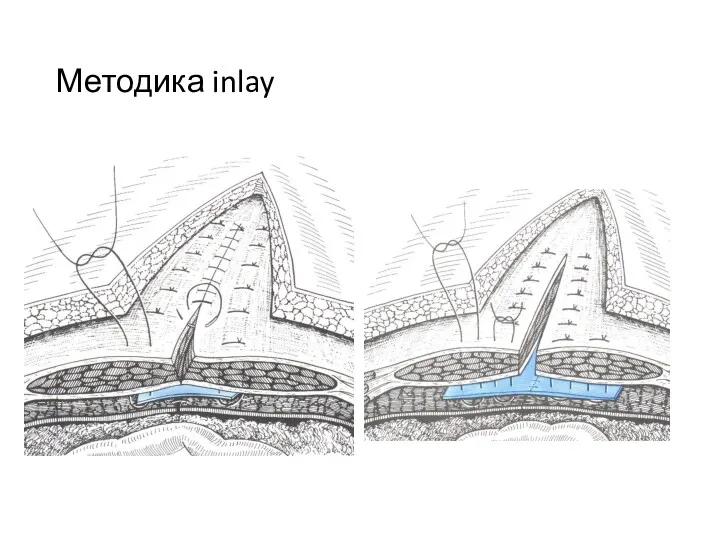 Методика inlay