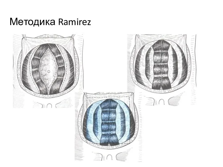 Методика Ramirez