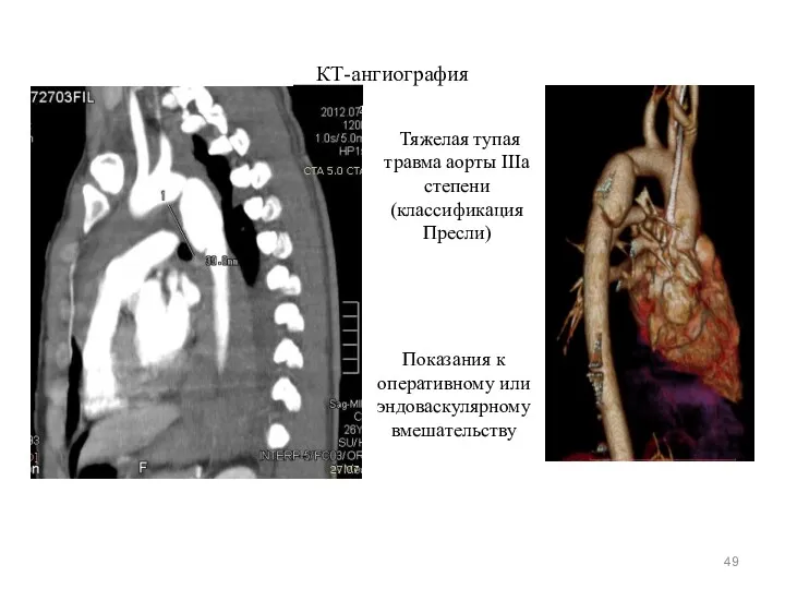 КТ-ангиография Тяжелая тупая травма аорты IIIa степени (классификация Пресли) Показания к оперативному или эндоваскулярному вмешательству