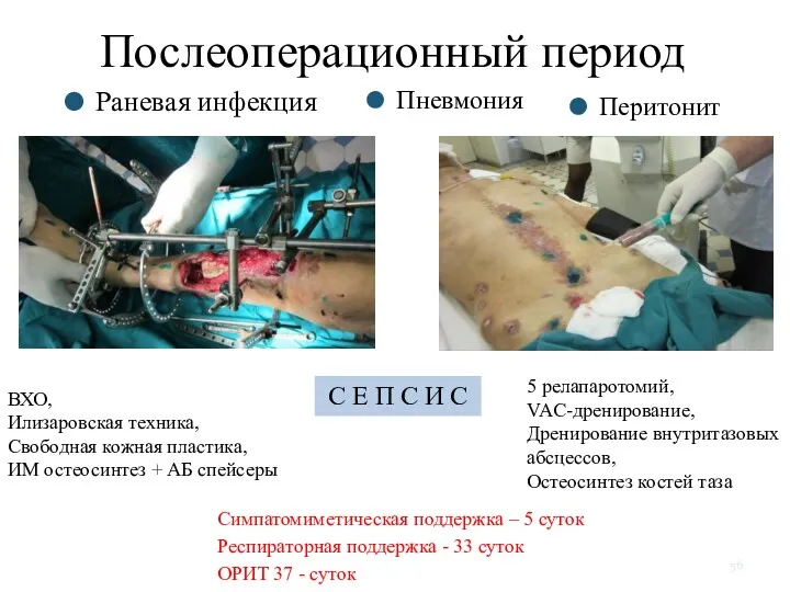 Послеоперационный период Раневая инфекция Перитонит ВХО, Илизаровская техника, Свободная кожная