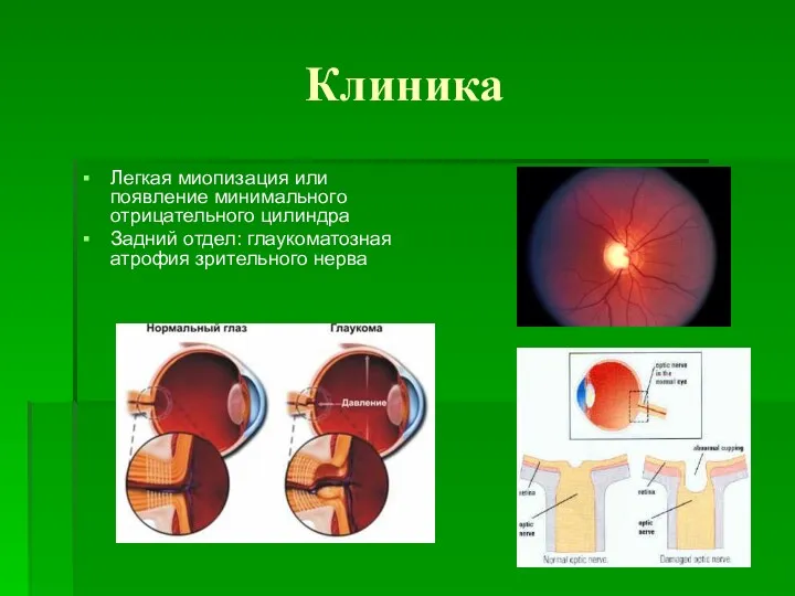 Клиника Легкая миопизация или появление минимального отрицательного цилиндра Задний отдел: глаукоматозная атрофия зрительного нерва