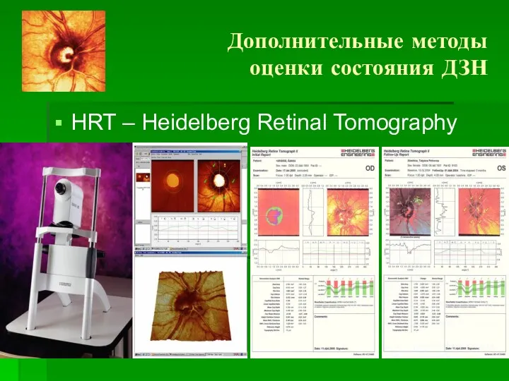 Дополнительные методы оценки состояния ДЗН HRT – Heidelberg Retinal Tomography