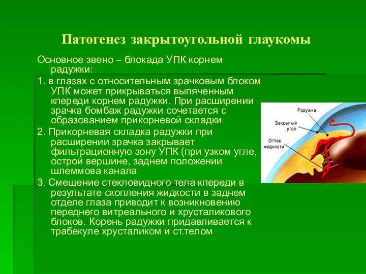 Патогенез закрытоугольной глаукомы Основное звено – блокада УПК корнем радужки: 1. в глазах